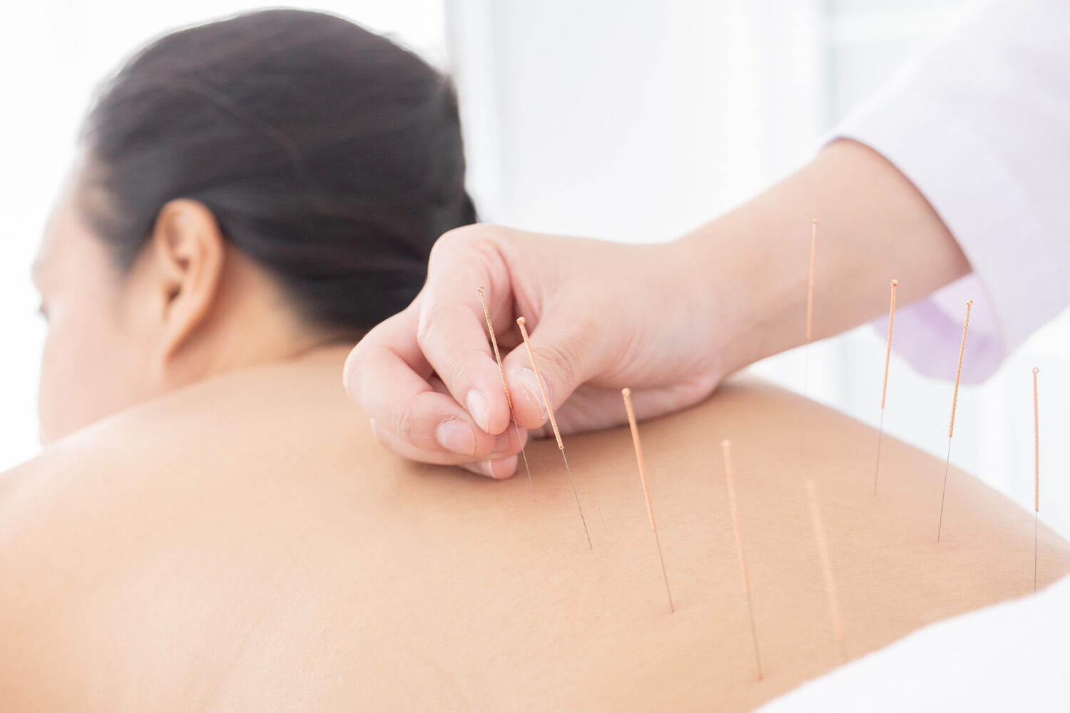 agopuntura